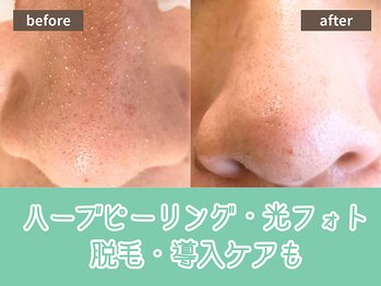 キザシ(kizashi)/最新毛穴ケア☆即実感！毛穴縮小