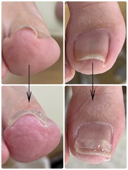 名古屋駅前巻き爪センター/陥入爪