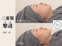 サロン ルイス アディクト(salon Lewis Addict)/小顔リフト