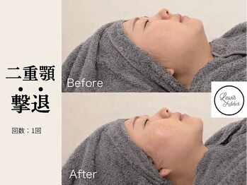 サロン ルイス アディクト(salon Lewis Addict)/小顔リフト