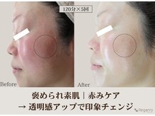 レガロビューティクリエイションズ桜川店/褒められ素肌｜赤みケア