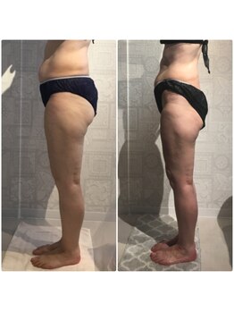 サンテボーテ(Sante Beaute)/痩身エステ