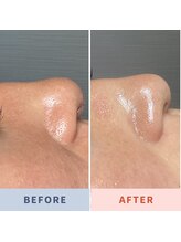 ソリス ビューティー(SOLIS BEAUTY)/毛穴洗浄