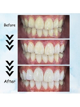 エクシアホワイトニング 塩釜口駅前店/20代前半の女性の効果事例