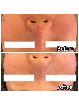 ドクター小顔 銀座店(Dr.小顔)/毛穴・赤み