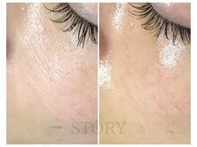 ストーリー(STORY)/ハーブピーリング専門店STORY