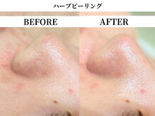 サンビ(SANBI)/肌荒れでお悩みの方必見！！