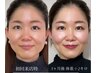 【フェイスライン実感】たるみ・むくみに集中美容鍼＋首肩土台鍼/90分