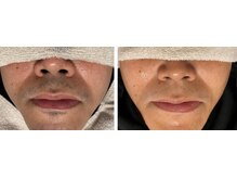 セブンボーテ(7Beaut'e)/ひげ脱毛♪