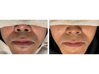 セブンボーテ(7Beaut'e)/ひげ脱毛♪