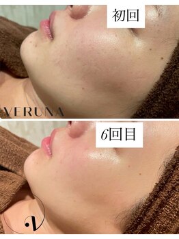 ココ 2号店(CoCo)/ハーブピーリング/肌質改善