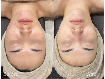 TD 鵜沼店/ハーブピーリング