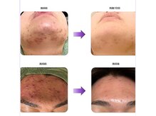 本気で肌質改善!ハーブピーリング♪ニキビ.しわ.シミケア.ハリ◎