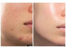 パールホワイトニングサロン 茅ヶ崎店/ハーブピーリング