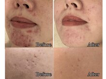 エルア 尼崎(Elua)の雰囲気（繰り返すニキビを根本からケアするニキビ専用ハーブピーリング★）