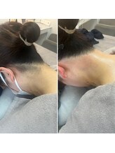 トリプルワン(111)/うなじワックス脱毛