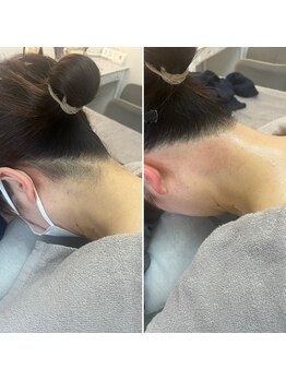 トリプルワン(111)/うなじワックス脱毛