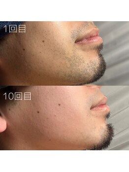 カナウ(KANAU)/ヒゲ脱毛（20代前半男性）