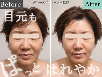 グレースフィオーレ 南越谷店(gracefiore)の写真/40代から気になるほうれい線・フェイスライン。頭からほぐし、超音波でハリのあるすっきり顔へ
