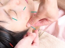 ナディ鍼灸治療院/美容鍼