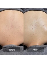 マヴィ(Mavie)/背中美人◎背中ハーブピーリング