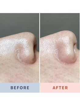 ソリス ビューティー(SOLIS BEAUTY)/毛穴洗浄