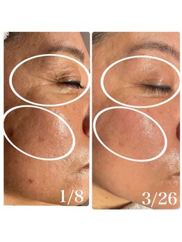 楚々(SOSO)/1回目からの肌変化に驚き！