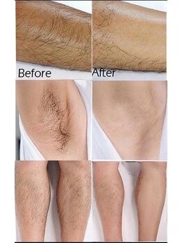 メンズエフディ ファウンデーション(メンズFD)/メンズ脱毛