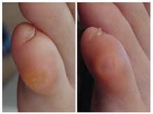 アンティ(Aunty)/小指のタコ（胼胝）