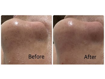 ケー(K)/毛穴洗浄×ワックス