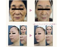 フェムプリュ(femplus)/エンダインフィニティ美肌小顔