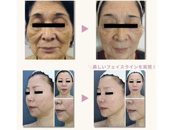 フェムプリュ(femplus)/エンダインフィニティ美肌小顔