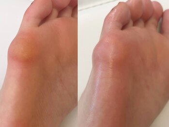 キラネイル アンド アイラッシュ by World Beauty(KIRA)/タコ除去 フットケア