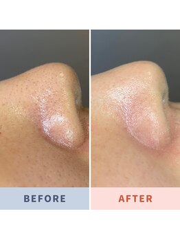 ソリス ビューティー(SOLIS BEAUTY)/毛穴洗浄