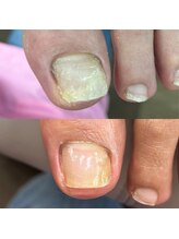 ウェルズユキ(well's yuki)/変形爪（剥離した爪）