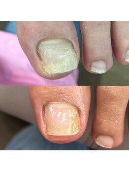 ウェルズユキ(well's yuki)/変形爪(剥離した爪)