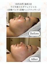 シーフェイス 横浜店(SEE FACE)/ラジオ波小顔コルギ+炭酸パック