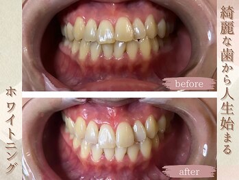 ラナ(LaNa)/綺麗な歯は人生を変える