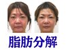 【脂肪分解４cc】顔には落とすべきの脂肪と保つべきの脂肪がある