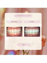 プラスビー 2号店(+b)/ホワイトニングビフォーアフター
