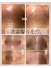 【毛穴の黒ずみ卒業】毛穴洗浄+幹細胞導入+幹細胞パック