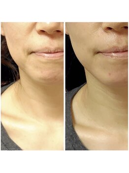 イル 名取店(iru)/糸式リフトアップフェイシャル