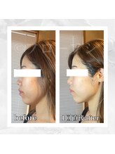 フローフシ∞/【小顔】20代女性症例写真