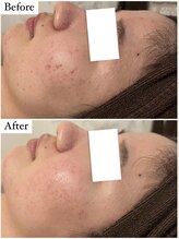 ベル 恵比寿(Belle)/REVI陶肌ハーブピーリング