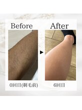 サロン ルイ(salonRui)/足脱毛　before　afuta