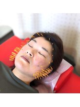 よつば鍼灸整骨院 春日院/美容鍼