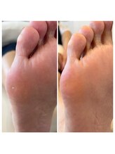 サロンドエー 帝塚山(Salon de A)/足裏に硬くて痛いとこない？