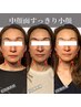 【ほうれい線改善】 小顔集中改善コースお試し 約75-90分