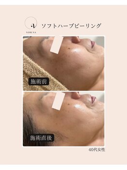 リレア ラカ(Relair Laka)/ソフトハーブピーリング