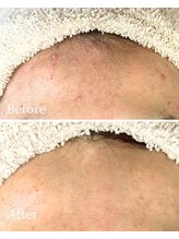 ニキビケア研究所 横浜店/おでこニキビでお悩みの方へ